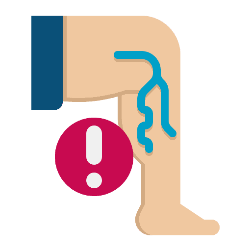 varicose-veins